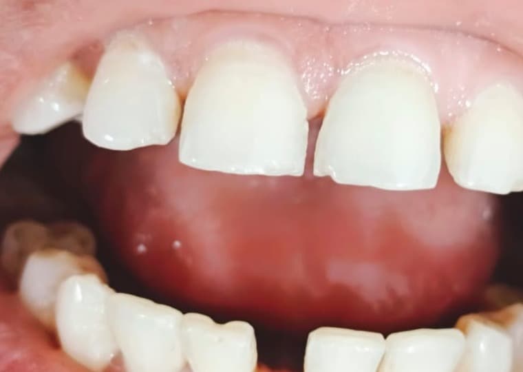 Before treatment