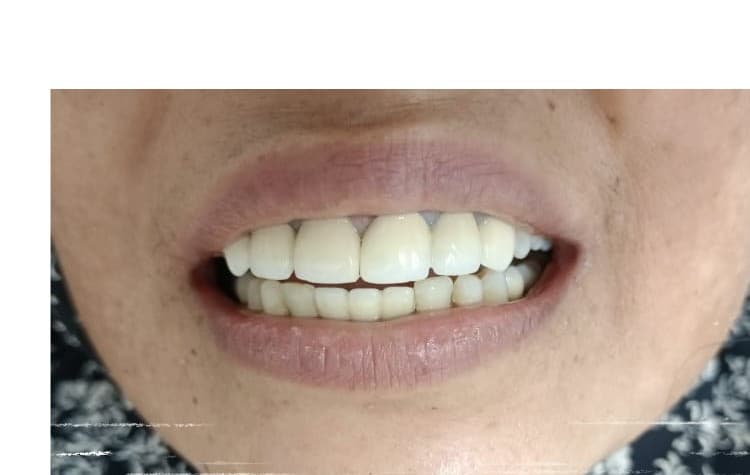 After treatment