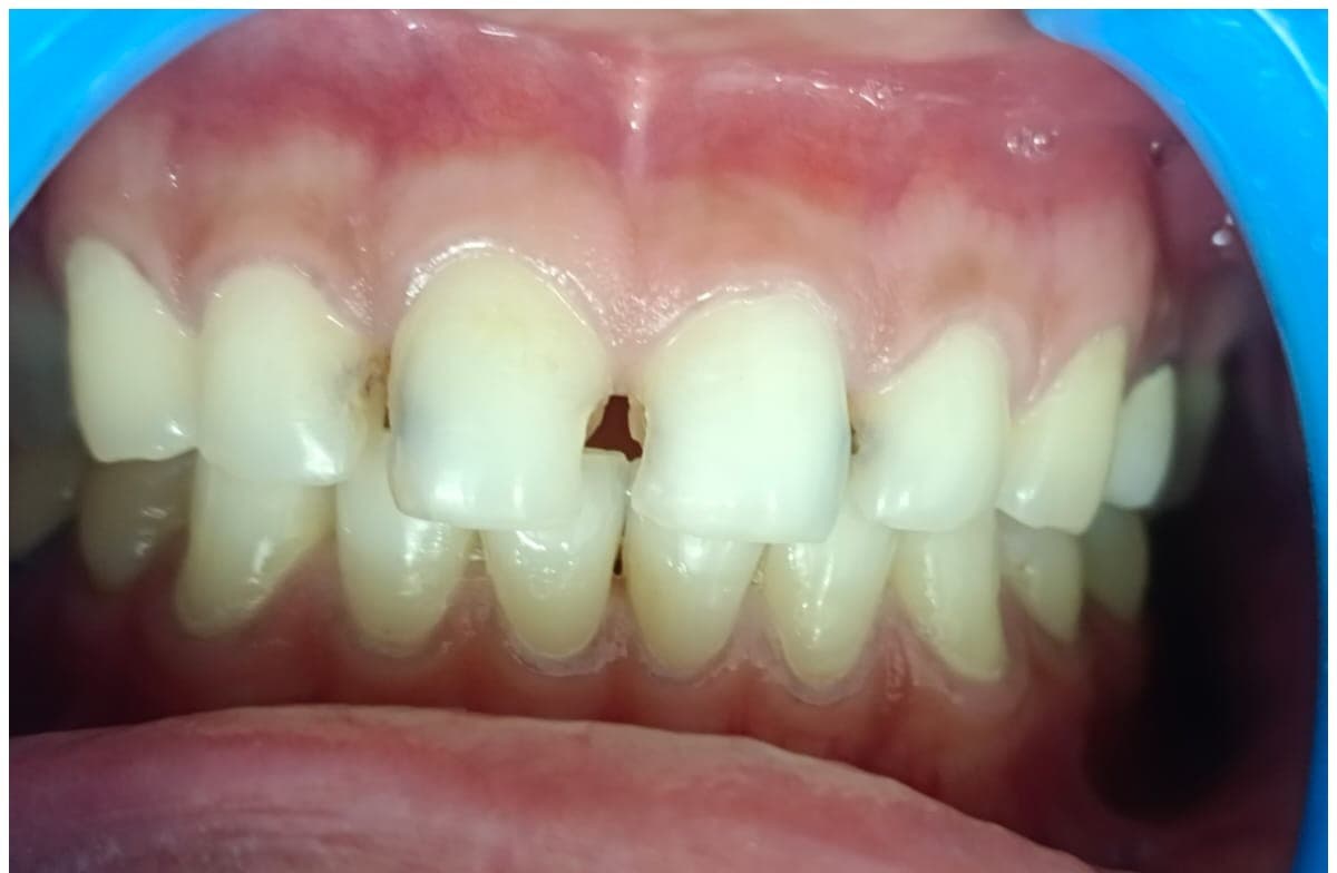 Before treatment
